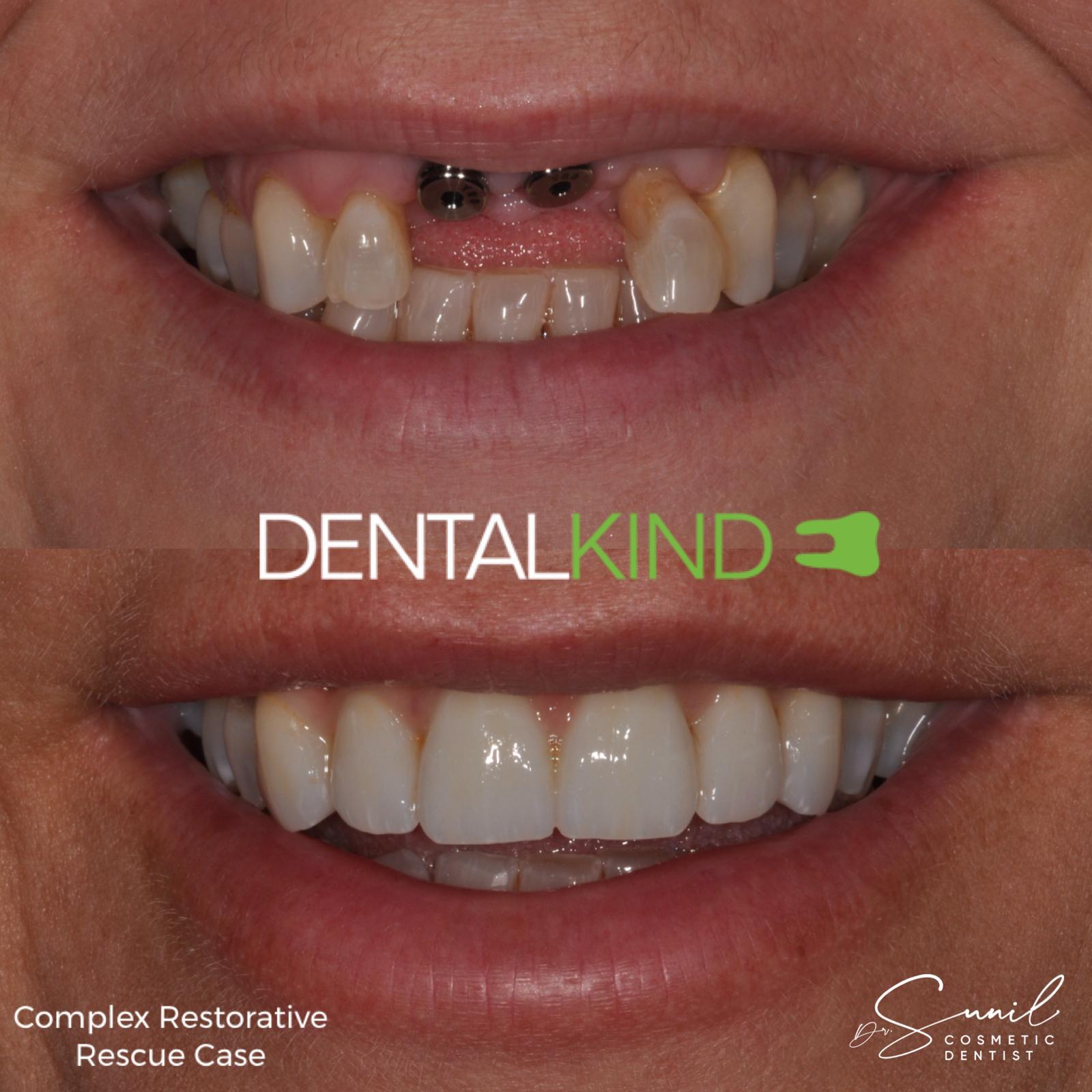 Before and after implant restoration, DentalKind Billericay