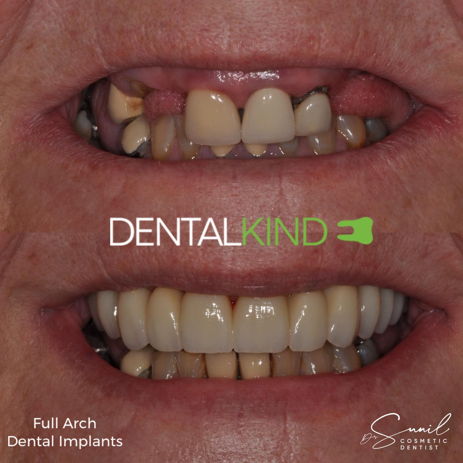 Before and after full-arch implants, DentalKind Billericay