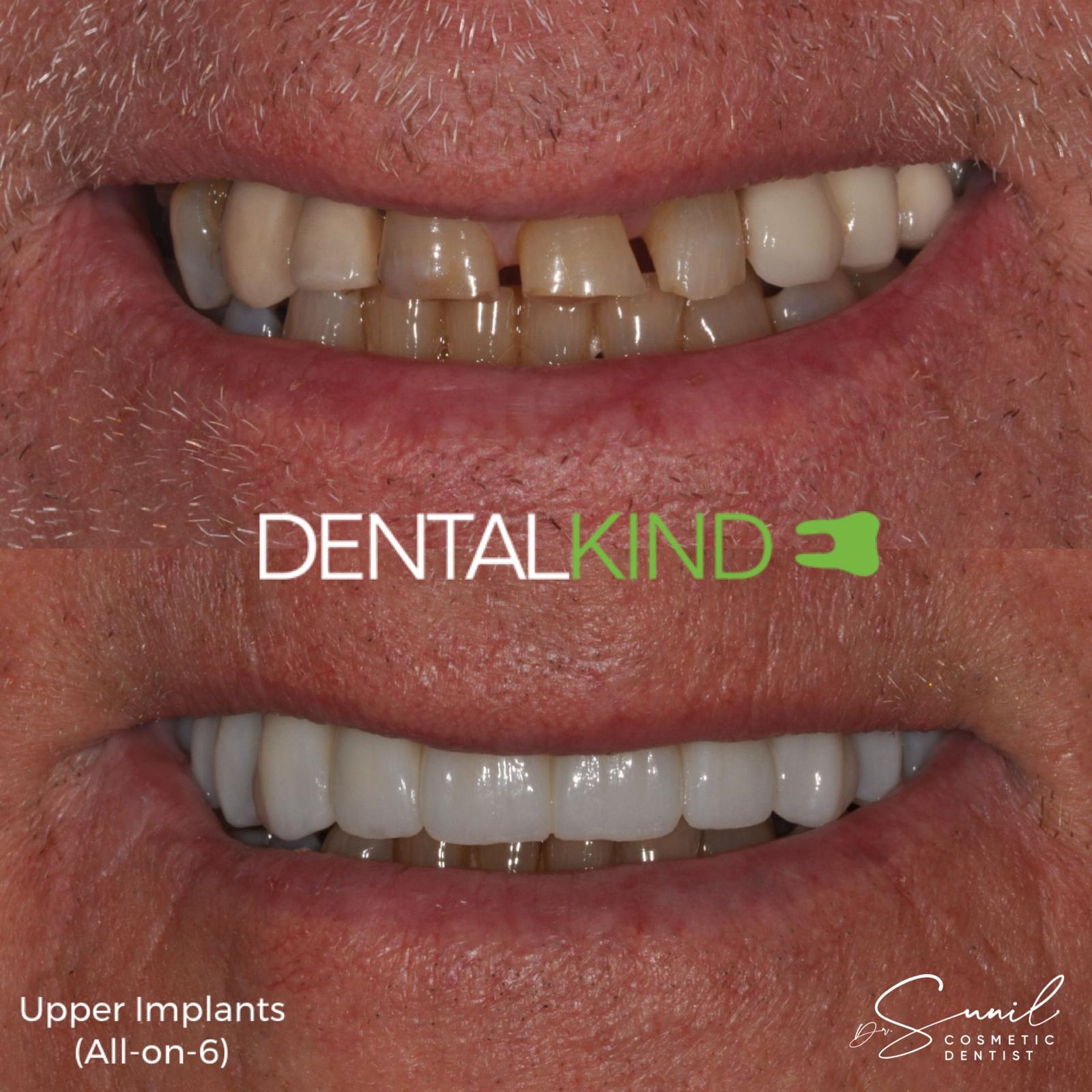 Before and after All-on-6 full arch implants, DentalKind Billericay