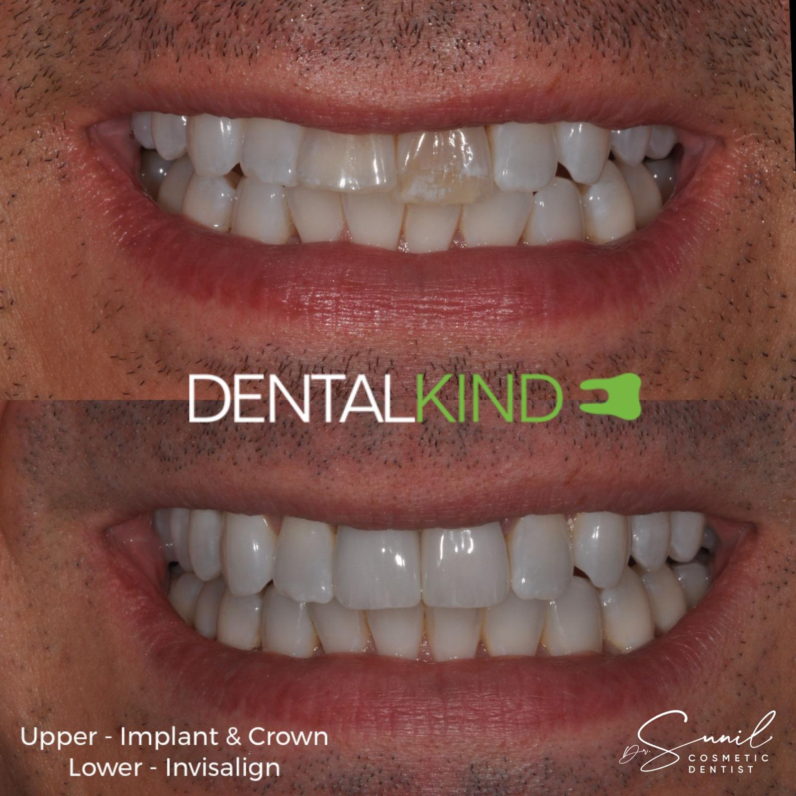 Before and after single tooth implant, DentalKind Billericay